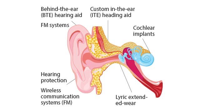 Sonova Shortens Product Development Time for Hearing Aids and Implants with Model-Based Design