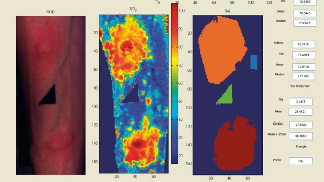 Hyperspectral  images from The University of Nottingham, derived by shining light on the tissue surface and accurately measuring oxygen levels and generating oxygen saturation maps to facilitate the work of clinical researchers and doctors.