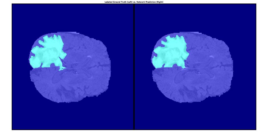 Segmented tumor in brain tissue using MATLAB with labeled ground truth (left) and network prediction (right).