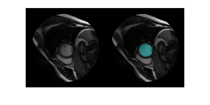 Cardiac Left Ventricle Segmentation from Cine-MRI Images Using U-Net Network